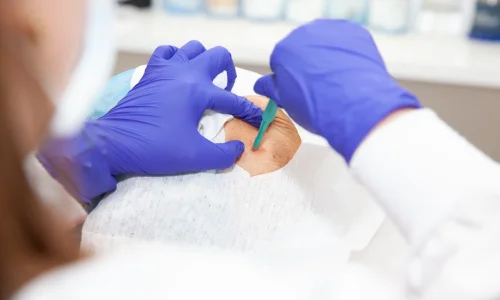 Sentinel lymph node biopsy